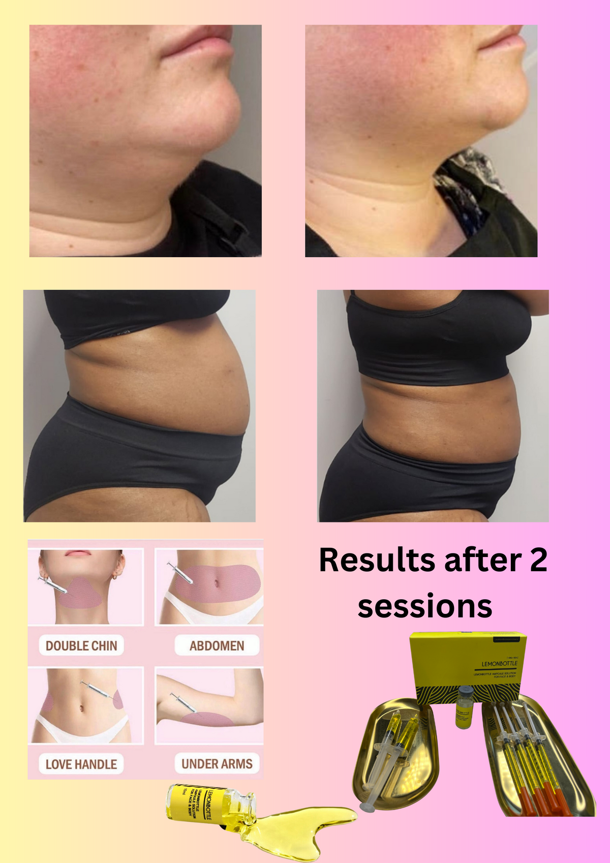 Fat Dissolving injections Bristol -ZYRA SKIN CLINIC