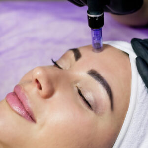 MICRONEEDLING FACIAL BRISTOL - ZYRA SKIN CLINIC