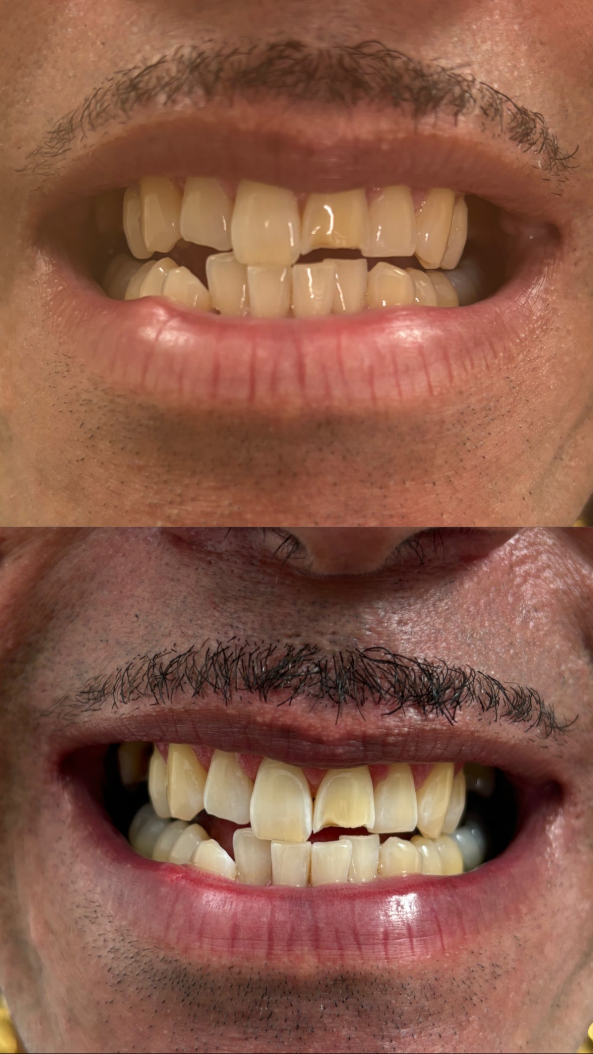 Teeth Whitening Sessions