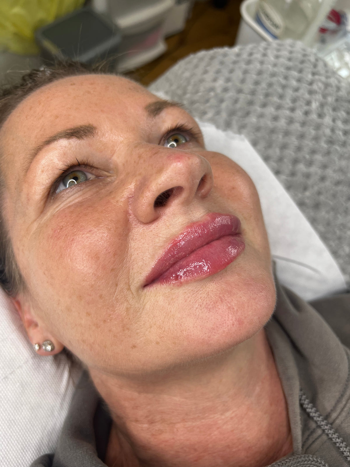 LIP FILLER -  ZYRA SKIN CLINIC
