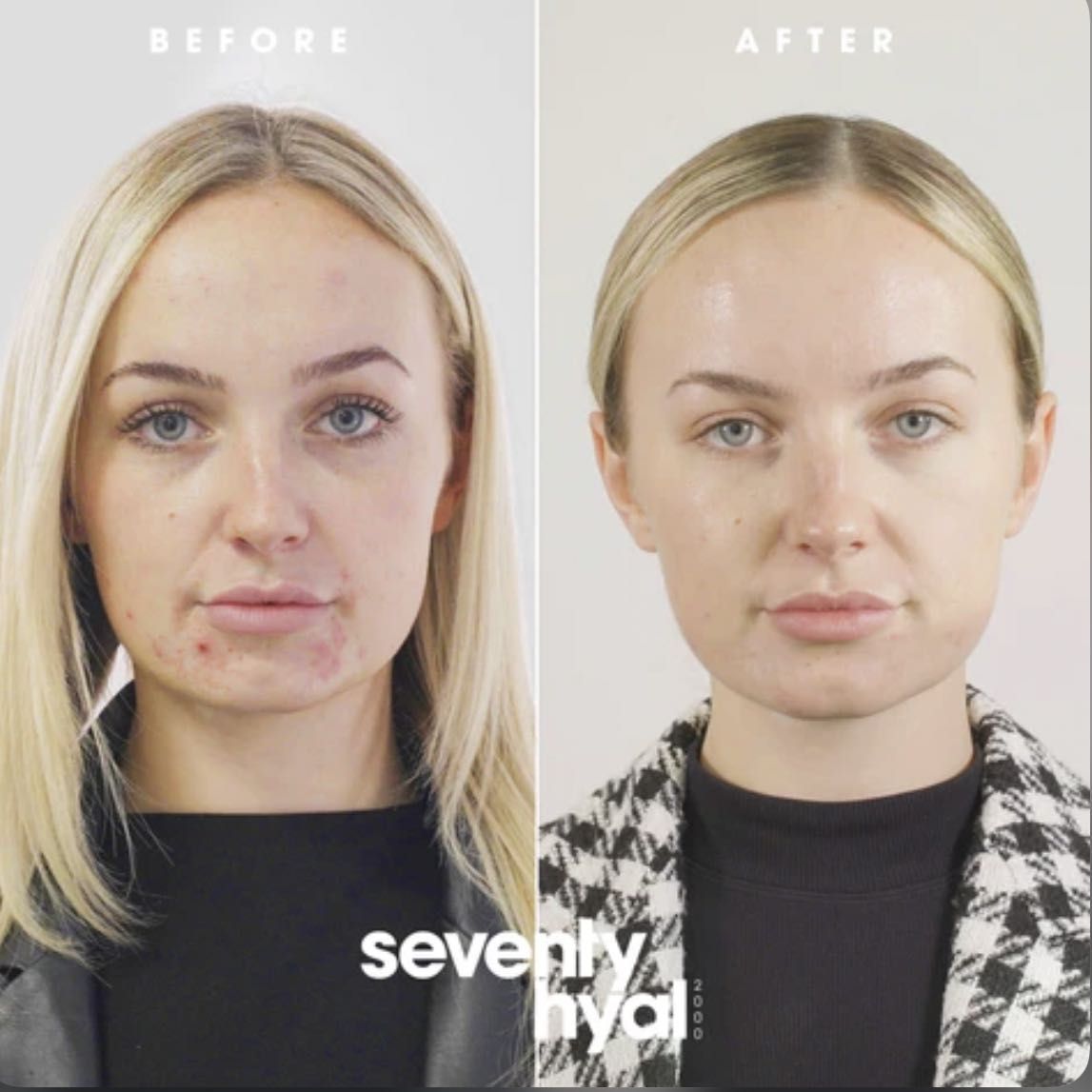 SKIN BOOSTER | SKIN HYDRATION | SEVENTY HYAL | LEMON BOTTLE