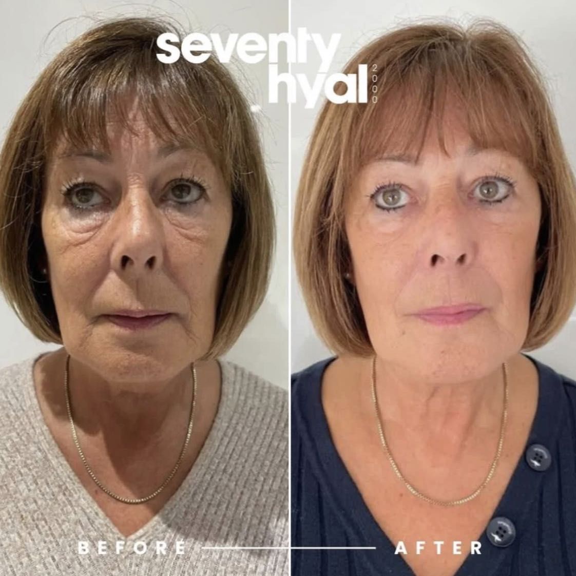 SKIN BOOSTER | SKIN HYDRATION | SEVENTY HYAL | LEMON BOTTLE