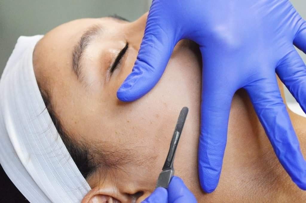 LUXE DERMAPLANING BRISTOL -  ZYRA SKIN CLINIC