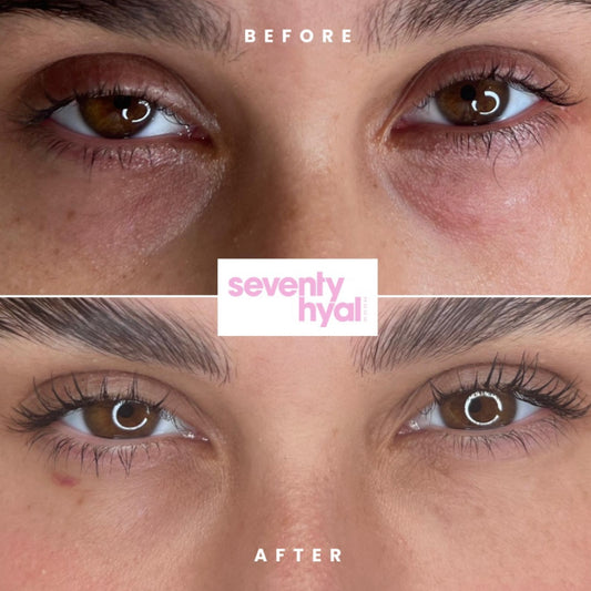SEVENTY HYAL| SKIN BOOSTER TREATMENT BRISTOL| TEAR TROUGH BRISTOL| TEAR TROUGH NEAR ME 