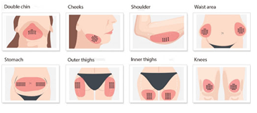 Fat Dissolving injections Bristol -ZYRA SKIN CLINIC