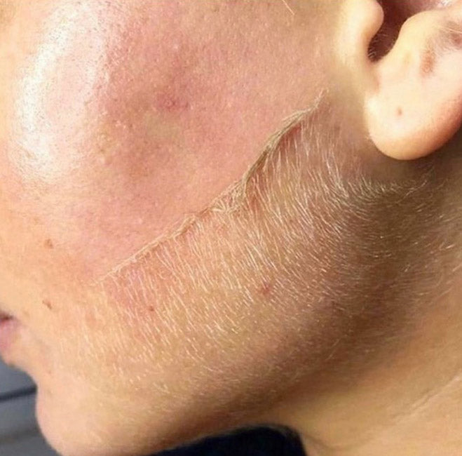 LUXE DERMAPLANING BRISTOL -  ZYRA SKIN CLINIC