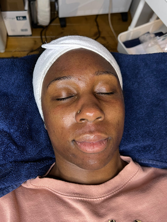 ULTIMATE FACIAL GLOW | FACIAL PACKAGES BRISTOL -  ZYRA SKIN CLINIC