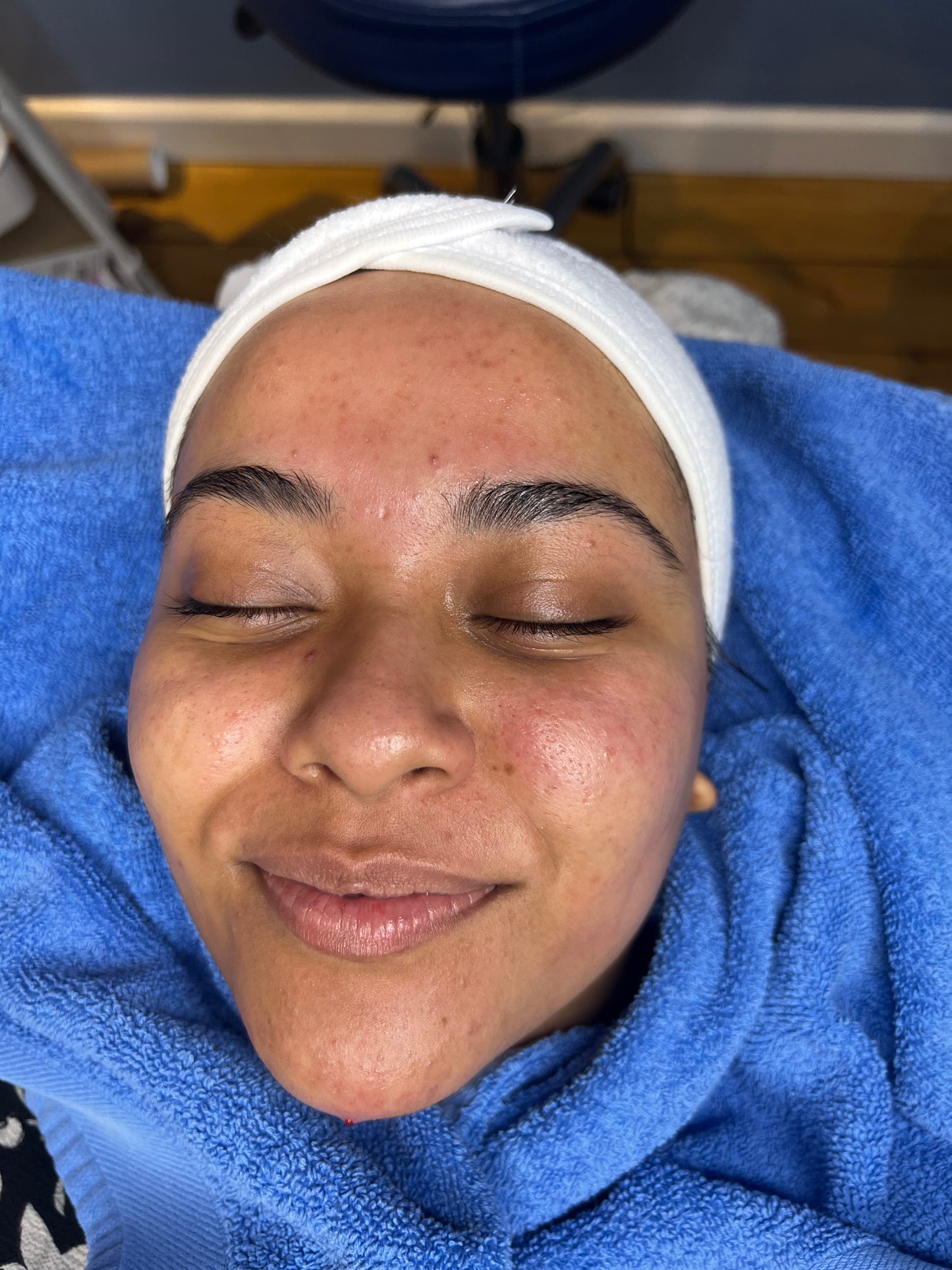 ULTIMATE FACIAL GLOW | FACIAL PACKAGES BRISTOL -  ZYRA SKIN CLINIC