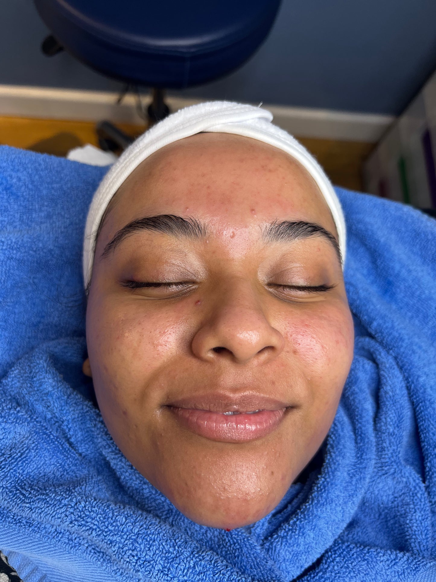ULTIMATE FACIAL GLOW | FACIAL PACKAGES BRISTOL -  ZYRA SKIN CLINIC