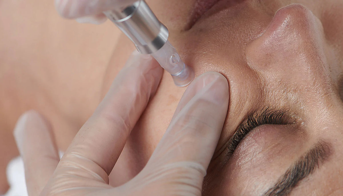 MICRONEEDLING FACIAL BRISTOL -  ZYRA SKIN CLINIC