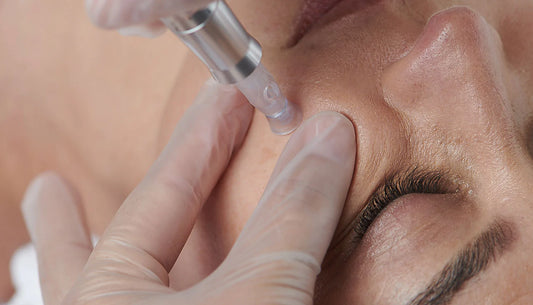 MICRONEEDLING FACIAL BRISTOL -  ZYRA SKIN CLINIC